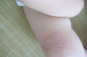 濕疹的預防方法有哪些