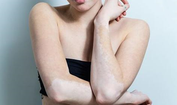 白癜風瘙癢的原因和解決方法