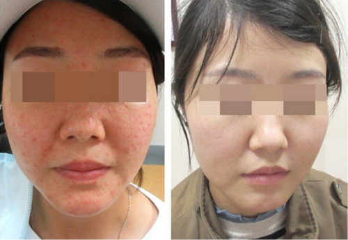 �L�����￴�^����Ƥ�ױ��^��