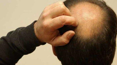 長春病理性脫發如何治療