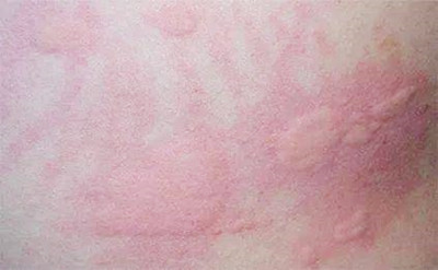 蕁麻疹的癥狀有哪些