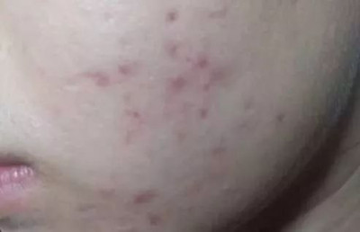 長春如何治療凸起的痤瘡疤痕