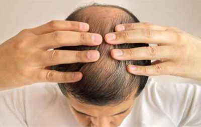 頭頂脫發(fā)有什么辦法能解決嗎
