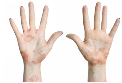 濕疹反復發作怎么辦?能治好嗎