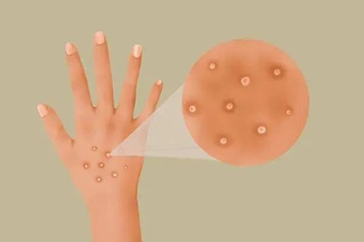 夏季手長(zhǎng)水泡、發(fā)癢,還蛻皮?因?yàn)辄c(diǎn)啥?