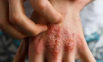 夏季濕疹高爆發?如何有效避免反復發作呢?